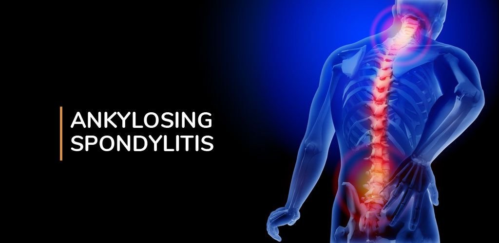 Ankylosing Spondylitis
